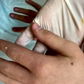 Удаление бородавок в Алматы