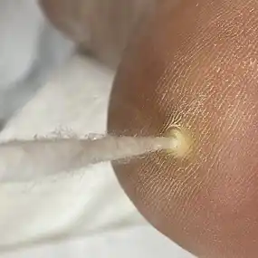 Удаление папиллом и бородавок жидким азотом: фото