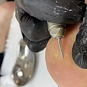 Удаление папиллом и бородавок жидким азотом: фото