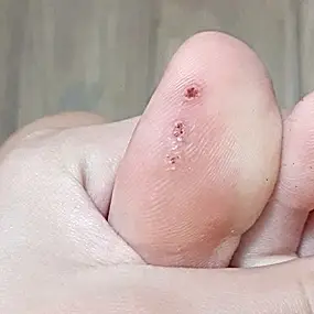 Удаление папиллом и бородавок жидким азотом: фото