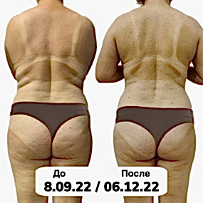 LPG массаж Фото до и после