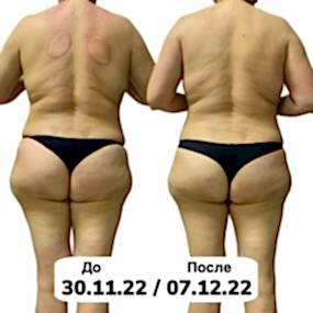 LPG массаж Фото до и после