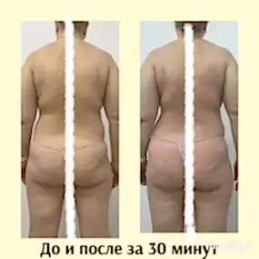 LPG массаж Фото до и после