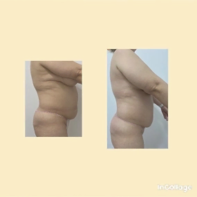 LPG массаж Фото до и после