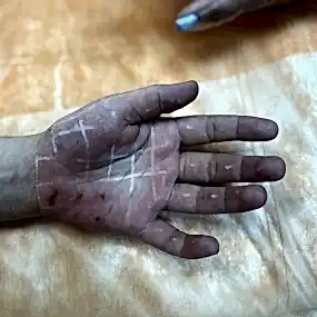 Лечение гипергидороза ладоней Алматы на Дону Мерси Подгальская