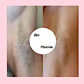 Лазерная эпиляция в Алматы