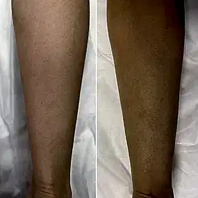 Лазерная эпиляция ног в Алматы