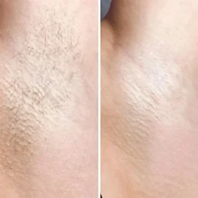 Лазерная эпиляция подмышек в Алматы