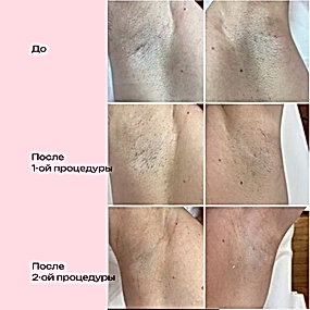 Лазерная эпиляция в Алматы