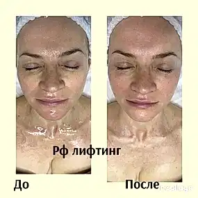 РФ лифтинг результат за одну процедуру 