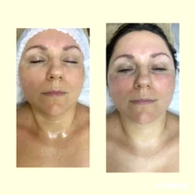 РФ лифтинг результат за одну процедуру 