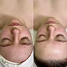 Механическая ручная чистка лица, фото до и после, Мерси Алматы