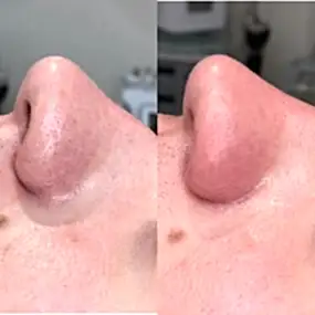 Ультразвуковая чистка лица фото результата