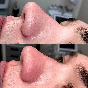 Чистка лица ультразвуком фото результата