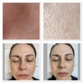 УЗ чистка лица фото результата