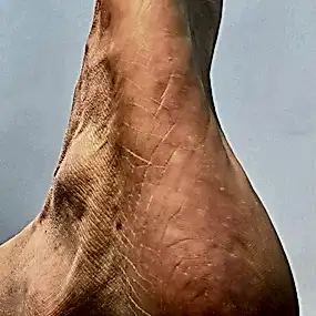 Медицинский педикюр