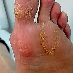 Медицинский педикюр