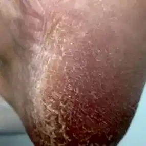 Медицинский педикюр