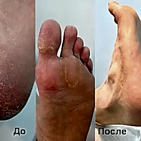 Медицинский педикюр