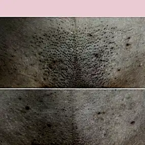 Лазерная эпиляция глубоко бикини в Алматы, фото до и после