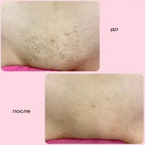 Лазерная эпиляция глубоко бикини в Алматы, фото до и после