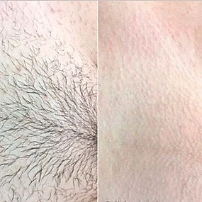 Лазерная эпиляция глубоко бикини в Алматы, фото до и после