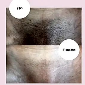 Лазерная эпиляция глубоко бикини в Алматы, фото до и после