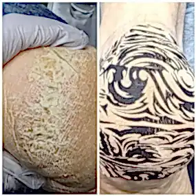 Медицинский педикюр