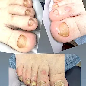 Обработка грибковой инфекции