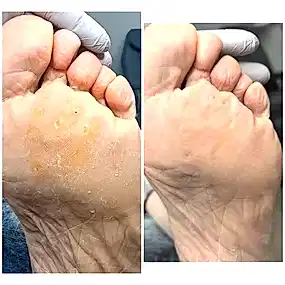 Обработка мозолей