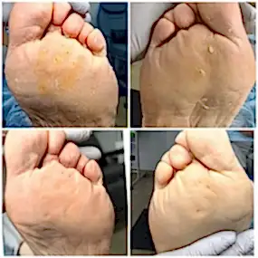 Обработка стоп