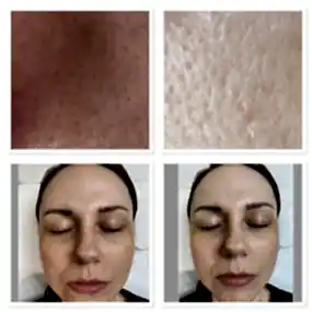 Голливудская чистка с кислородом