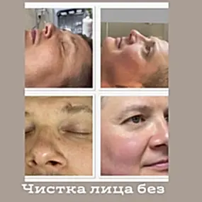 Атравматичная чистка лица Hydrafacial