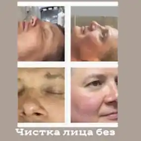 Атравматичная чистка лица Hydrafacial