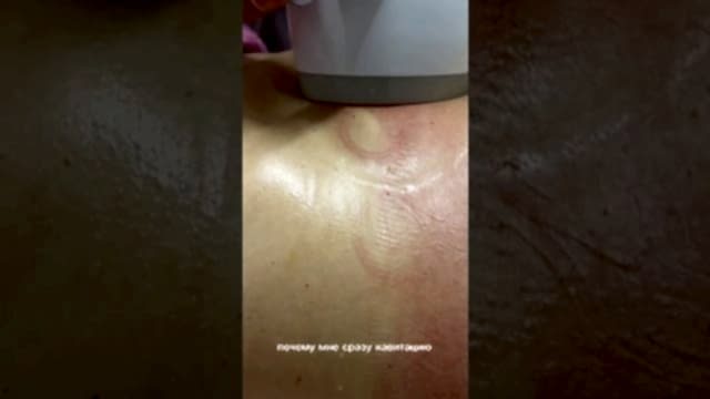 Посмотреть видео Жиротопка похудение в Мерси Алматы Картинка для элемента Жиротопка похудение в Мерси Алматы